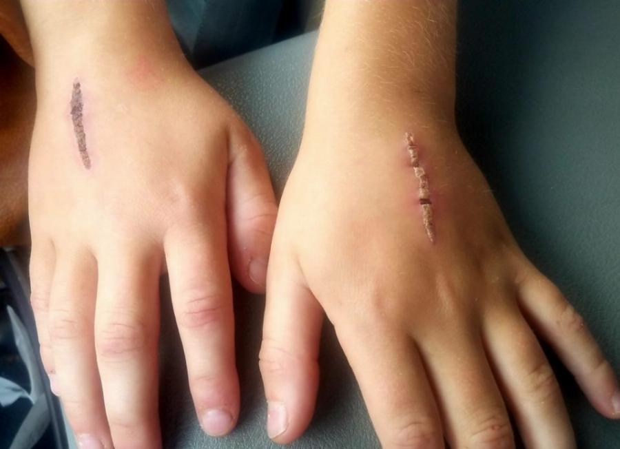 Νέα ανόητη «πρόκληση» που έχει ξεκινήσει στα σχολεία: Γυρνούν σπίτι με πληγωμένα χέρια