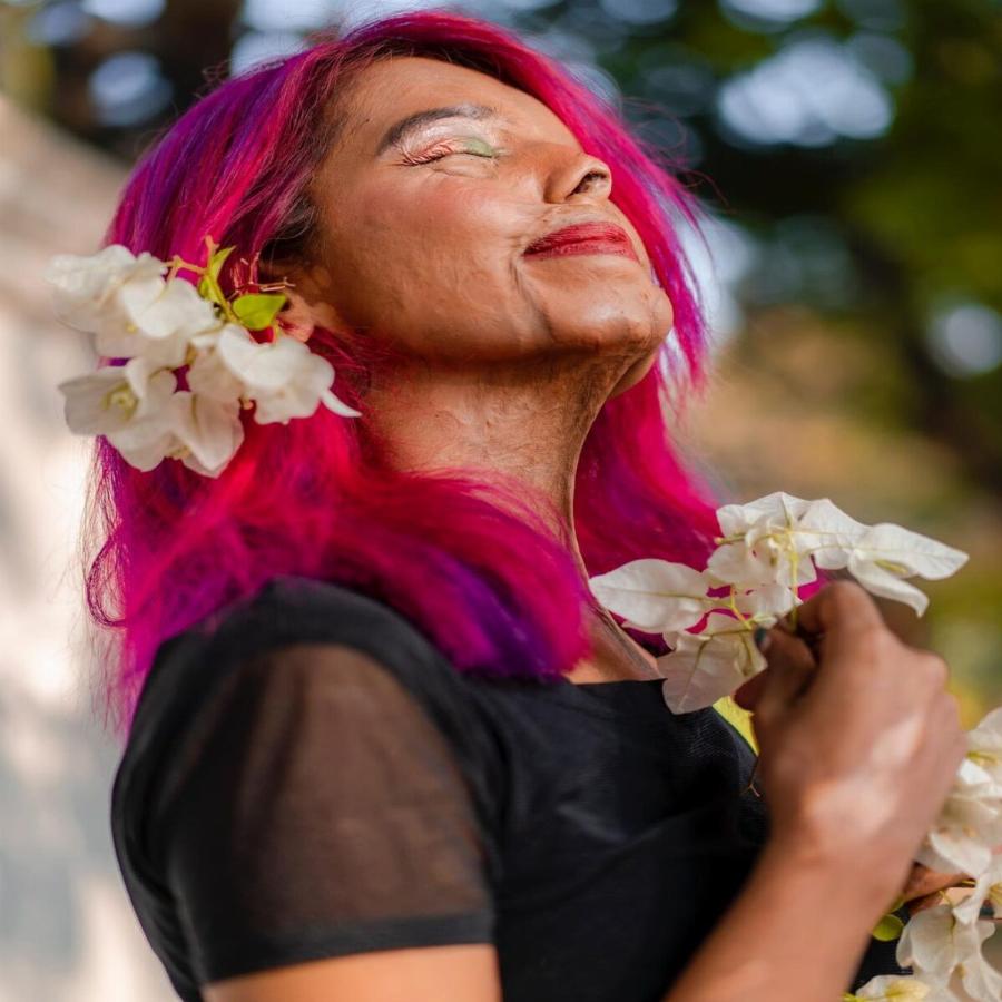 Δύο μηνών της έριξε οξύ στο πρόσωπο ο πατέρας της: Σήμερα είναι μοντέλο και εμπνέει τους πάντες