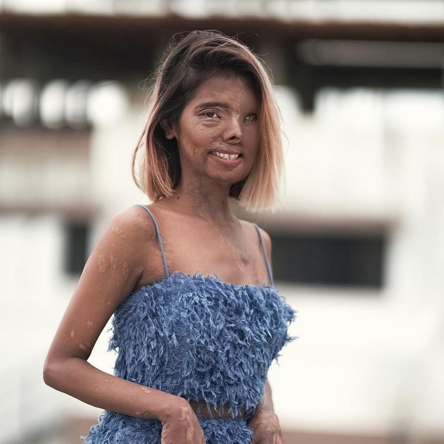 Δύο μηνών της έριξε οξύ στο πρόσωπο ο πατέρας της: Σήμερα είναι μοντέλο και εμπνέει τους πάντες