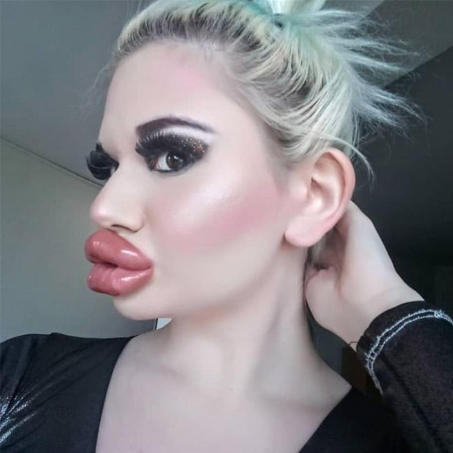 Εθισμένη στα προθέματα τετραπλασίασε το μέγεθος των χειλιών της: Εικόνες μιας Βουλγάρας που σοκάρουν