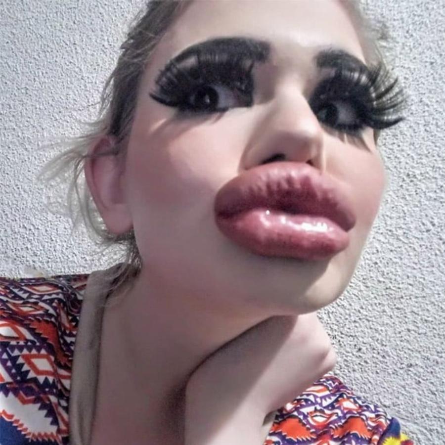 Εθισμένη στα προθέματα τετραπλασίασε το μέγεθος των χειλιών της: Εικόνες μιας Βουλγάρας που σοκάρουν