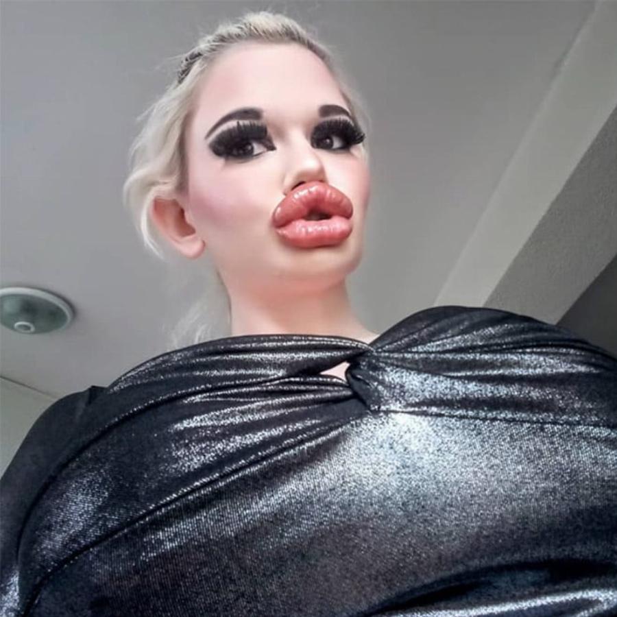 Εθισμένη στα προθέματα τετραπλασίασε το μέγεθος των χειλιών της: Εικόνες μιας Βουλγάρας που σοκάρουν