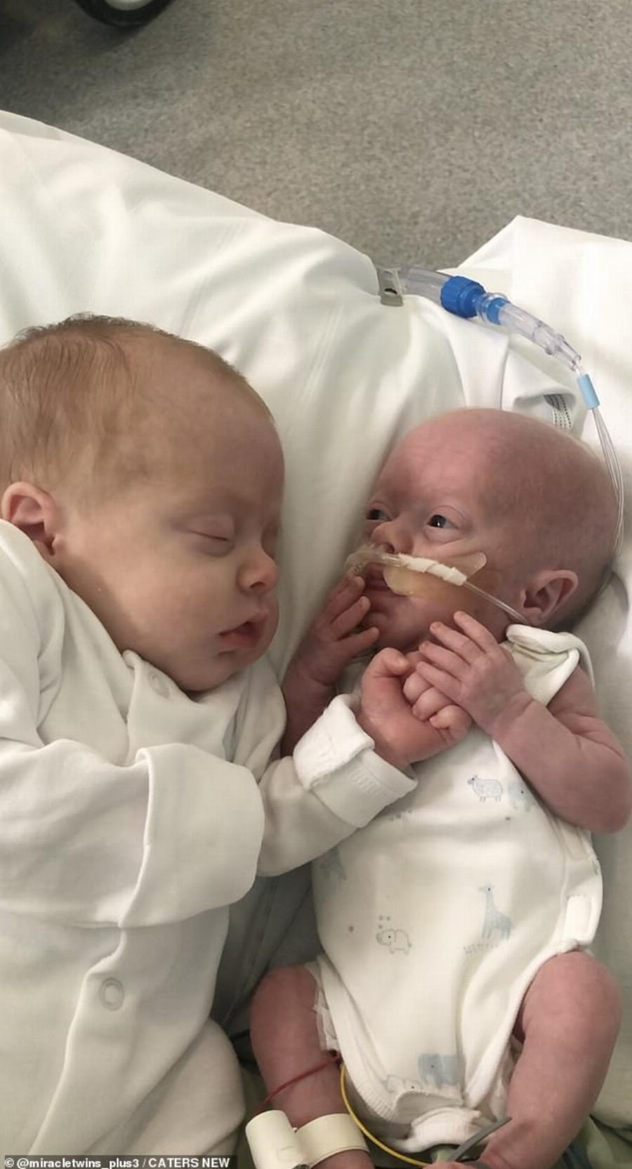 Φοβερό περιστατικό: Πρόωρο μωρό πάλεψε για τη ζωή του και πήρε δύναμη από το δίδυμο αδερφάκι του