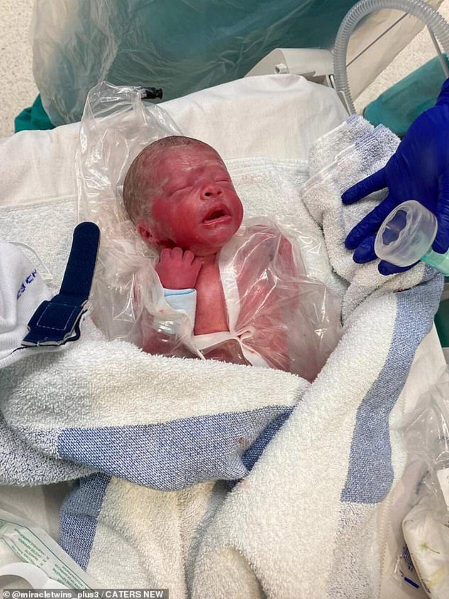 Φοβερό περιστατικό: Πρόωρο μωρό πάλεψε για τη ζωή του και πήρε δύναμη από το δίδυμο αδερφάκι του