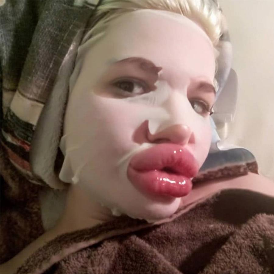 Εθισμένη στα προθέματα τετραπλασίασε το μέγεθος των χειλιών της: Εικόνες μιας Βουλγάρας που σοκάρουν