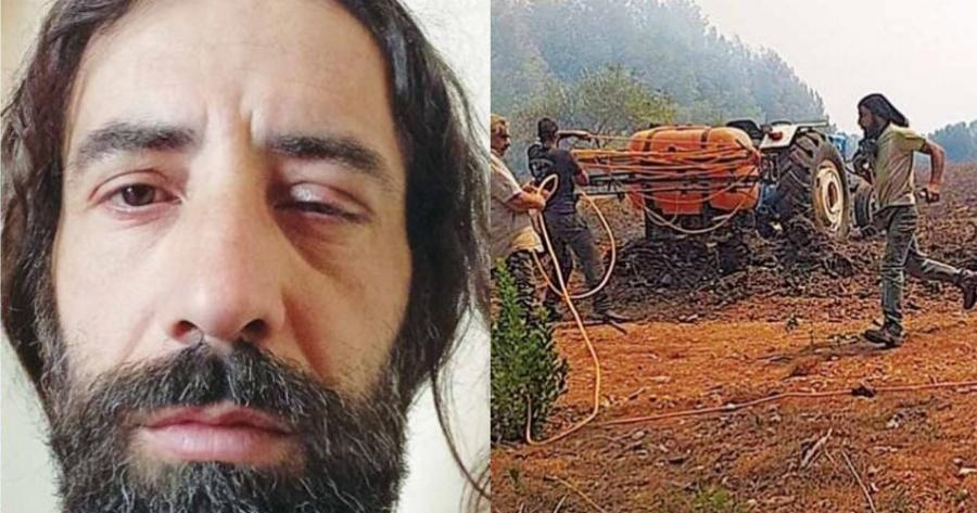 Έχασε την όραση από το ένα μάτι του στις φωτιές του Αυγούστου