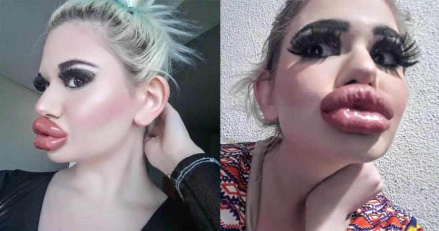 Εθισμένη στα προθέματα τετραπλασίασε το μέγεθος των χειλιών της: Εικόνες μιας Βουλγάρας που σοκάρουν