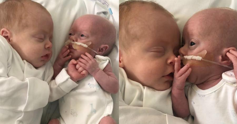 Φοβερό περιστατικό: Πρόωρο μωρό πάλεψε για τη ζωή του και πήρε δύναμη από το δίδυμο αδερφάκι του