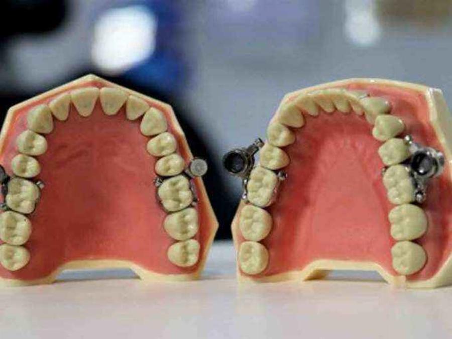 Νέα συσκευή για απώλεια βάρους εμποδίζει το στόμα να ανοίγει πάνω από 2 χιλιοστά