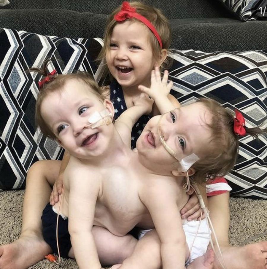 Σιαμαία κοριτσάκια: Γεννήθηκαν με ενωμένη κοιλιά και στήθος, επέζησαν από θαύμα