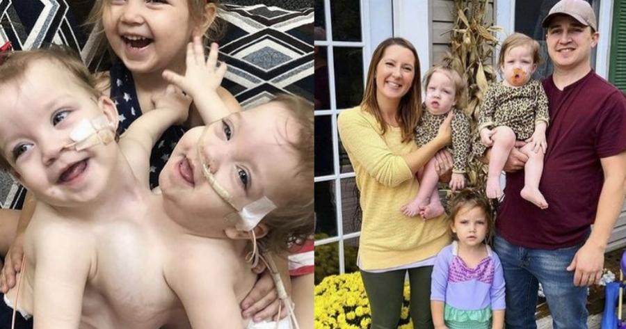 Σιαμαία κοριτσάκια: Γεννήθηκαν με ενωμένη κοιλιά και στήθος, επέζησαν από θαύμα