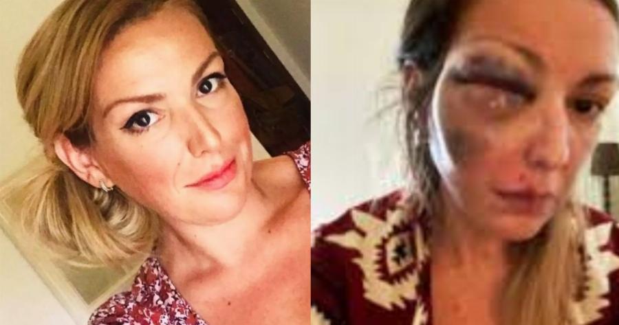 Την σακάτεψε στο ξύλο ο σύντροφος της – Παραμορφωμένη η Στεφανία Τζαφέρη