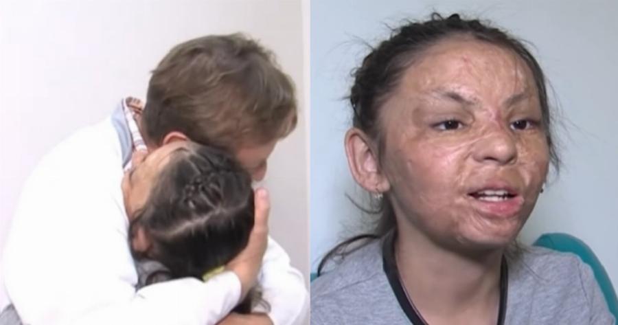 Συγκλονιστική ιστορία: Πλαστικός χειρούργος βοήθησε κοριτσάκι με σοβαρά εγκαύματα να αποκτήσει καινούριο πρόσωπο