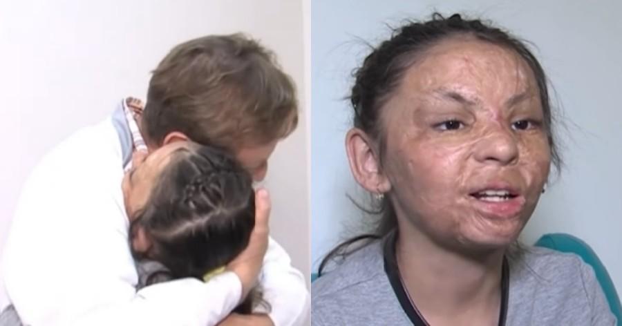 Συγκλονιστική ιστορία: Πλαστικός χειρούργος βοήθησε κοριτσάκι με σοβαρά εγκαύματα να αποκτήσει καινούριο πρόσωπο