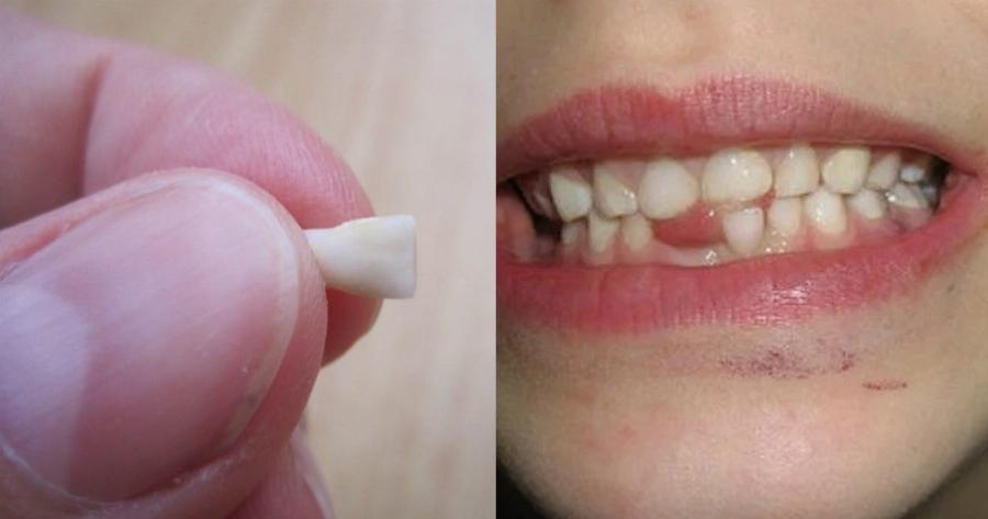 Γιατί επιβάλλεται να κρατάμε τα πρώτα δόντια των παιδιών μας