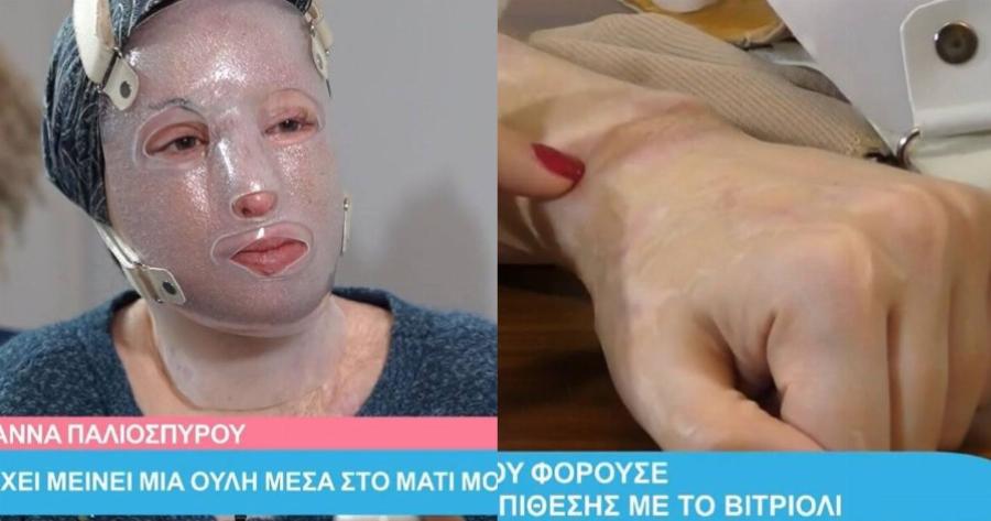 Δάκρυσε όλη η Ελλάδα: Η Ιωάννα έδειξε για πρώτη φορά τα εγκαύματά της και τα ρούχα που φόραγε την ημέρα της επίθεσης