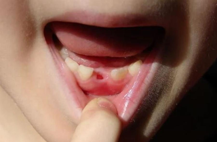 Γιατί επιβάλλεται να κρατάμε τα πρώτα δόντια των παιδιών μας