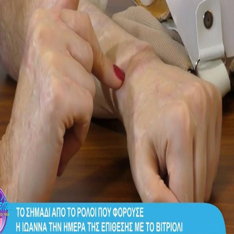 Δάκρυσε όλη η Ελλάδα: Η Ιωάννα έδειξε για πρώτη φορά τα εγκαύματά της και τα ρούχα που φόραγε την ημέρα της επίθεσης