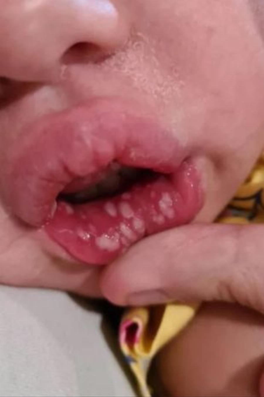 «Μην αφήνετε να φιλάνε το μωρό σας – η κόρη μου κόλλησε έρπη και βασανίζεται»