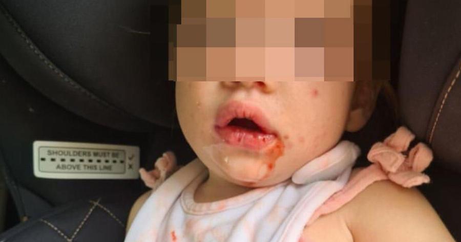 «Μην αφήνετε να φιλάνε το μωρό σας – η κόρη μου κόλλησε έρπη και βασανίζεται»