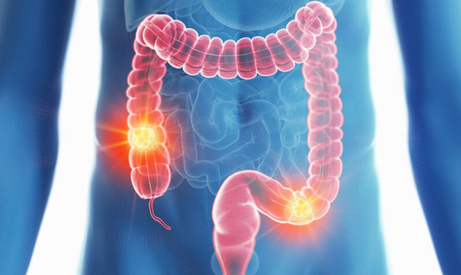 Καρκίνος Παχέος Εντέρου: Αυτή η εξέταση καταργεί την κολονοσκόπηση