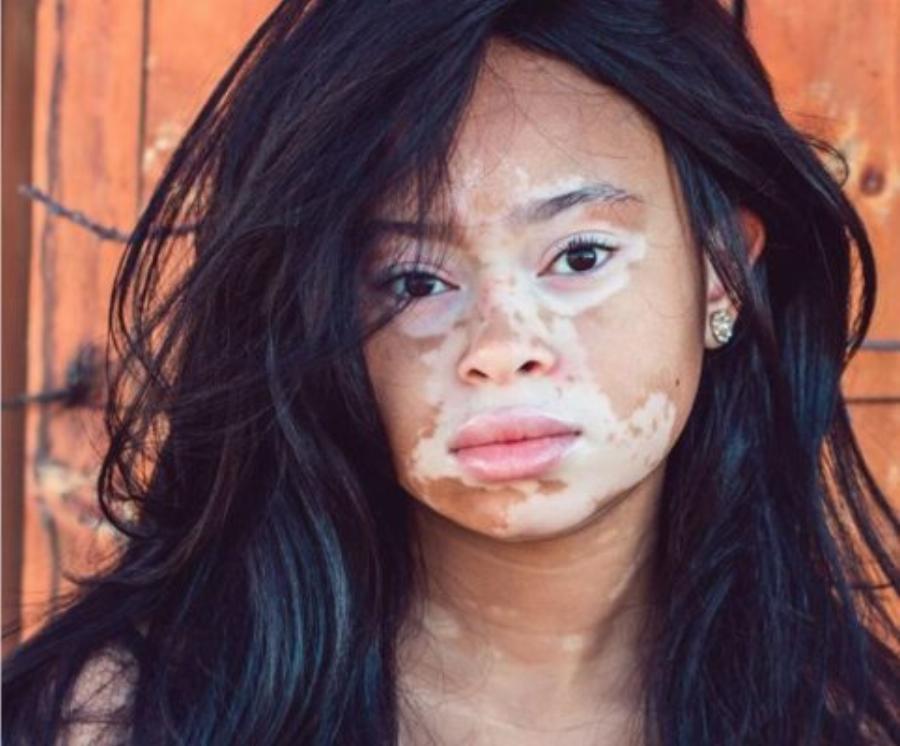 Αυτά τα 12 μοντέλα κατέρριψαν τα πρότυπα ομορφιάς και απέδειξαν ότι ο κάθε άνθρωπος είναι όμορφος