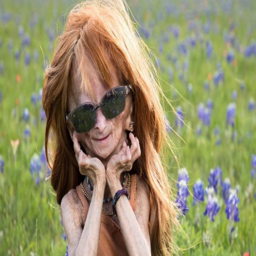 Μπέντζαμιν Μπάτον: Έφυγε από τη ζωή σε ηλικία μόλις 15 ετών το κορίτσι που γεννήθηκε με τη νόσο