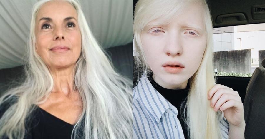 Αυτά τα 12 μοντέλα κατέρριψαν τα πρότυπα ομορφιάς και απέδειξαν ότι ο κάθε άνθρωπος είναι όμορφος