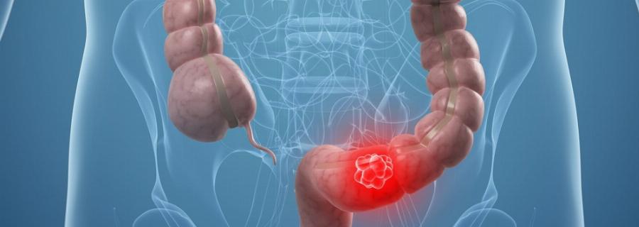 Νέα εξέταση μπορεί να διαγνώσει τον καρκίνο του εντέρου χωρίς κολονοσκόπηση