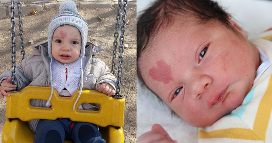 Νεογέννητο: Το σημάδι σε σχήμα καρδιάς στο πρόσωπο του που ξετρελαίνει το διαδίκτυο