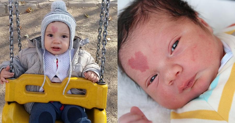 Νεογέννητο: Το σημάδι σε σχήμα καρδιάς στο πρόσωπο του που ξετρελαίνει το διαδίκτυο