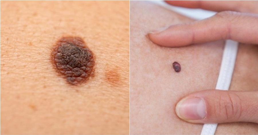 Προσοχή: Πώς καταλαβαίνουμε ποια ελιά είναι επικίνδυνη – Δεν είναι όλες οι ελιές αθώες στο δέρμα