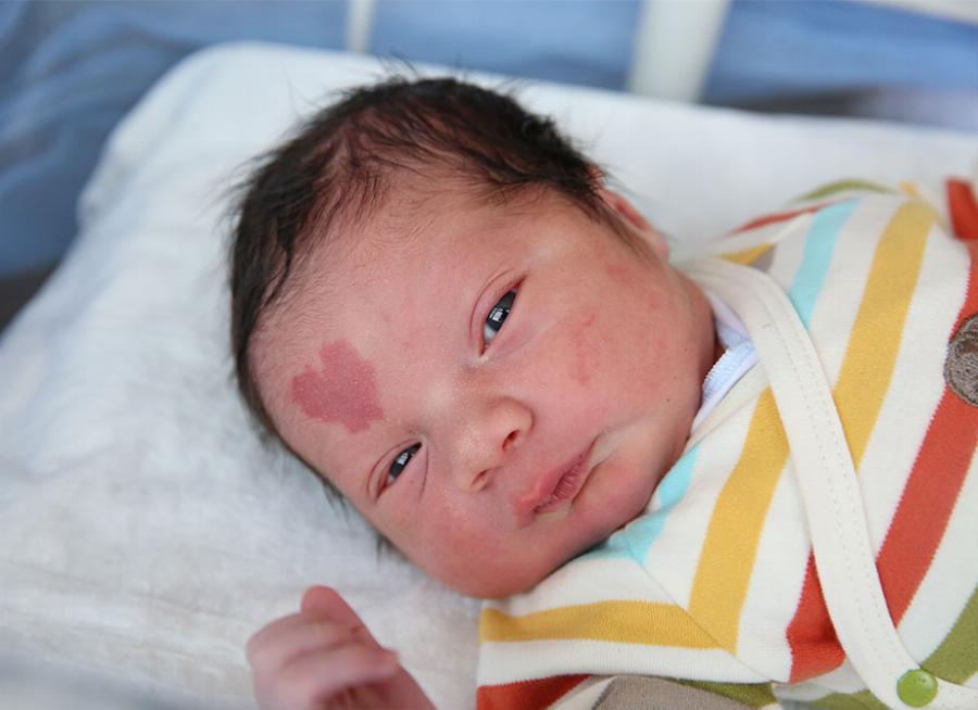 Νεογέννητο: Το σημάδι σε σχήμα καρδιάς στο πρόσωπο του που ξετρελαίνει το διαδίκτυο