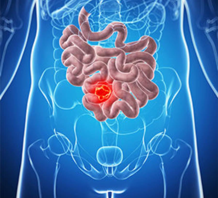 Νέα εξέταση μπορεί να διαγνώσει τον καρκίνο του εντέρου χωρίς κολονοσκόπηση