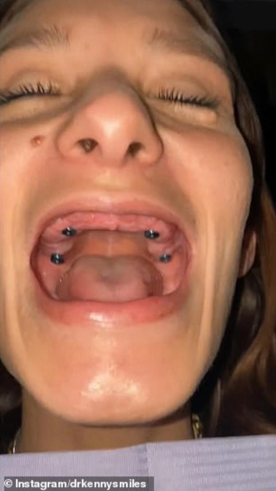 Γυναίκα έχασε όλα τα δόντια της από τις καταχρήσεις και ο οδοντίατρος την μεταμόρφωσε σε ένα πανέμορφο πλάσμα