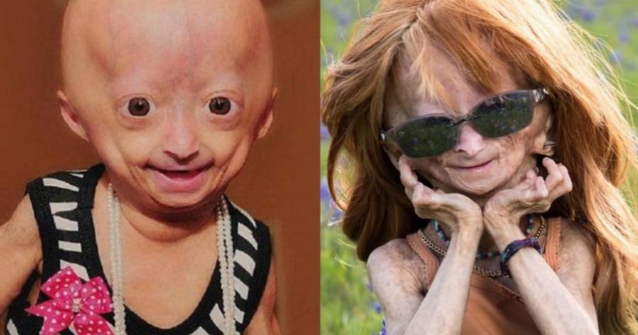 Μπέντζαμιν Μπάτον: Έφυγε από τη ζωή σε ηλικία μόλις 15 ετών το κορίτσι που γεννήθηκε με τη νόσο