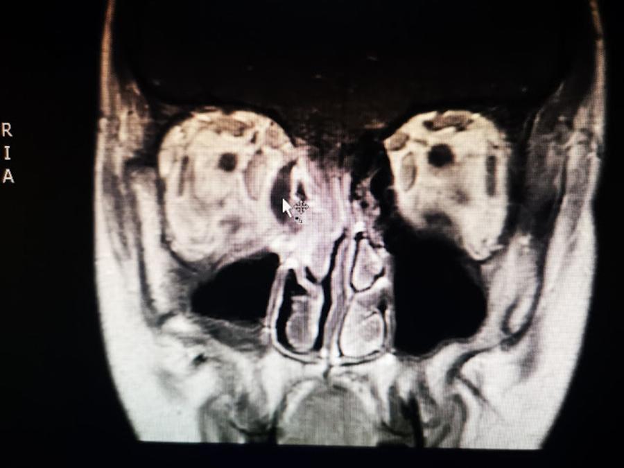 Πρωτοποριακή επέμβαση σε νοσοκομείο Ιωαννίνων: Έσωσαν την όραση παιδιού