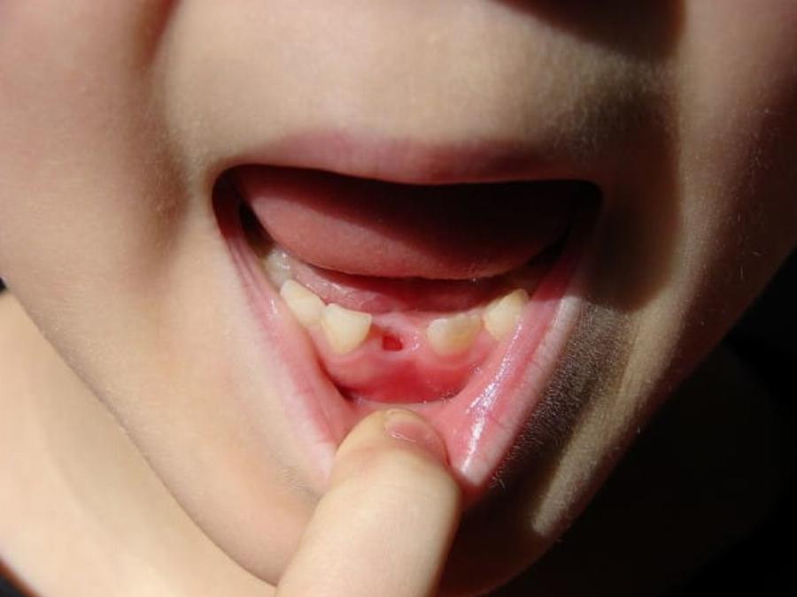 Πρώτα δόντια: Ο λόγος που επιβάλλεται να τα κρατάμε – Πως πρέπει να τα διατηρήσουμε