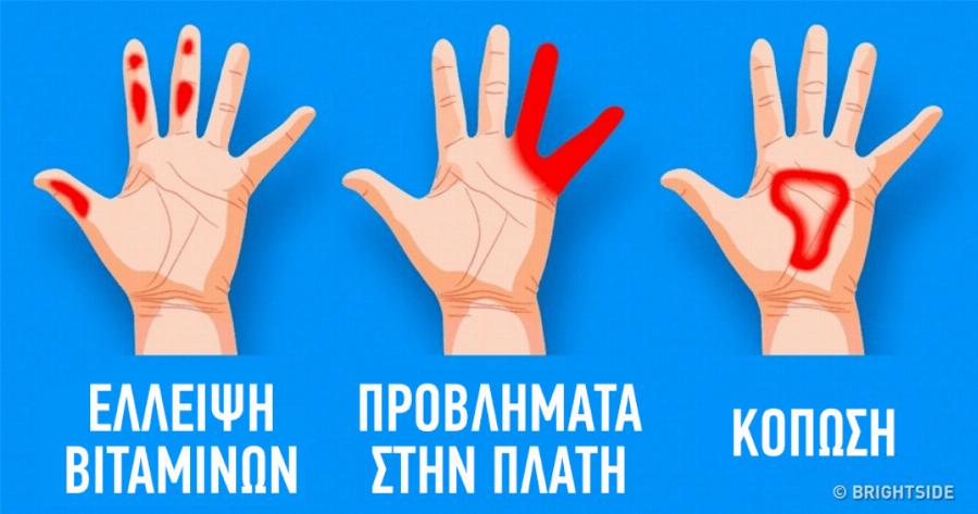 Τα 7 σημαντικά σημάδια στα χέρια μας που μαρτυρούν πράγματα για την υγεία μας