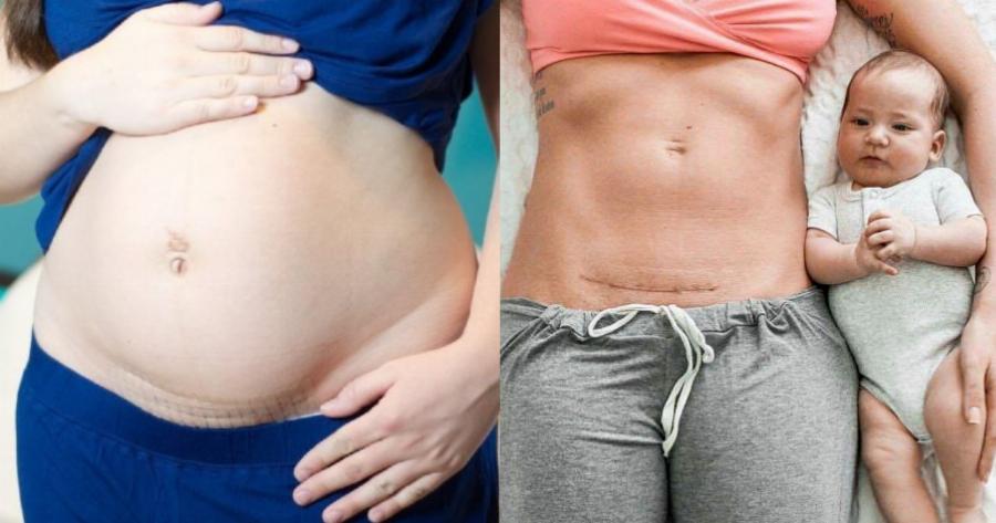 Μητέρα δείχνει την καισαρική τομή της και κλείνει το στόμα σε όσους την έκριναν πώς πήρε «τον εύκολο δρόμο»