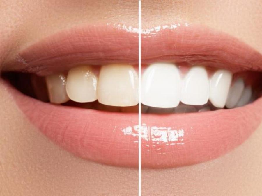 Κατάλευκα δόντια: Τα σπιτικά κόλπα για ένα λαμπερό χαμόγελο χωρίς επίσκεψη στον οδοντίατρο