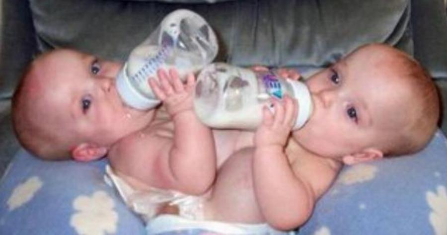 Σπάνιες σιαμαίες δίδυμες: Γεννήθηκαν το 2003, χειρουργήθηκαν για 24 ώρες, σήμερα είναι 2 όμορφες κοπέλες και ζουν ανεξάρτητα