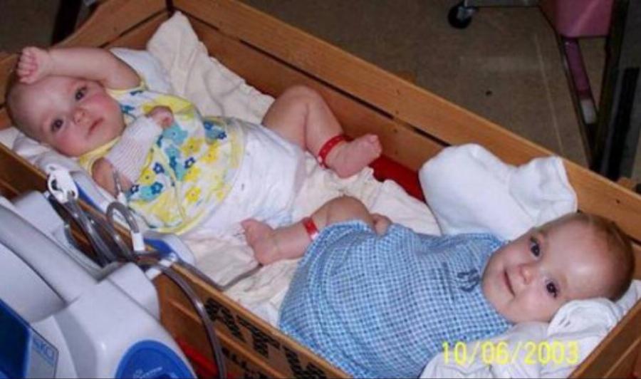 Σπάνιες σιαμαίες δίδυμες: Γεννήθηκαν το 2003, χειρουργήθηκαν για 24 ώρες, σήμερα είναι 2 όμορφες κοπέλες και ζουν ανεξάρτητα