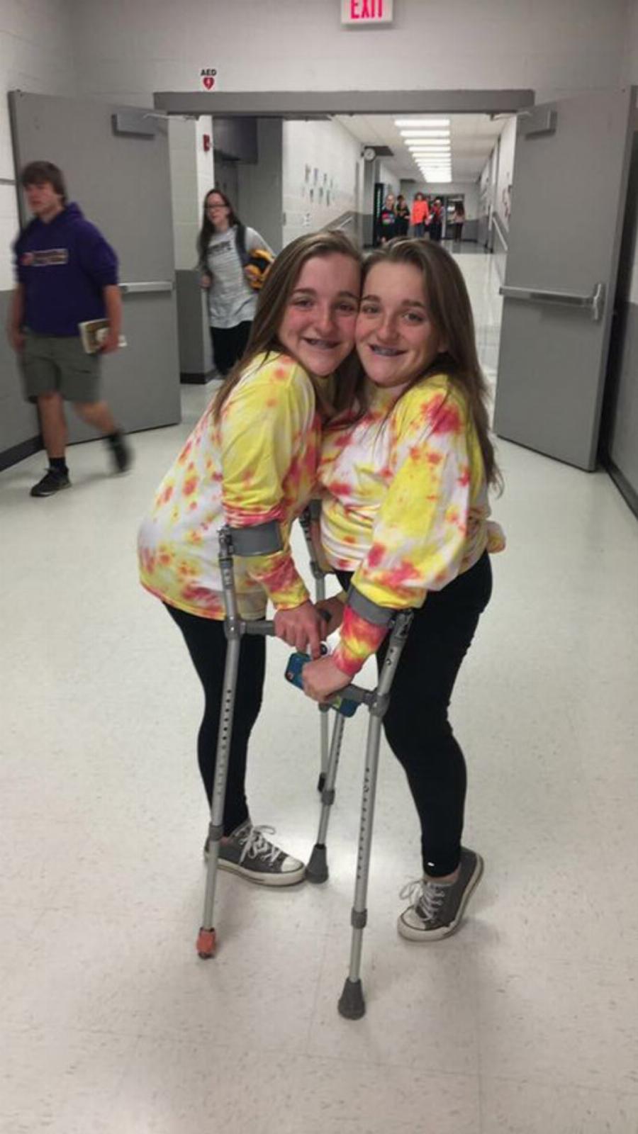 Σπάνιες σιαμαίες δίδυμες: Γεννήθηκαν το 2003, χειρουργήθηκαν για 24 ώρες, σήμερα είναι 2 όμορφες κοπέλες και ζουν ανεξάρτητα