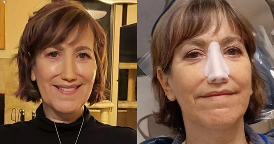 «Έπρεπε να αφαιρέσω τη μύτη μου ή να παλέψω με τον θάνατο, σήμερα όμως αισθάνομαι τυχερή»