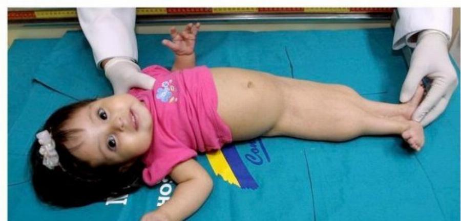 Σύνδρομο της γοργόνας: Το 10χρονο κορίτσι με την σπάνια ασθένεια, η μάχη για επιβίωση και το τραγικό τέλος