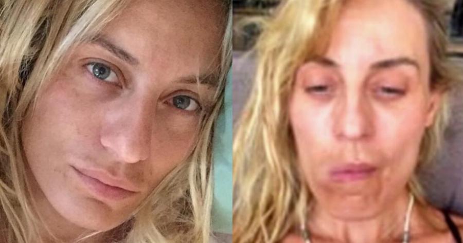 Ελεονώρα Μελέτη: «Τότε που έτρωγα καρότα, είχα τέλεια φουσκωτά χείλη και πυκνά μαλλιά. Άραγε θα το ξαναζήσω;»