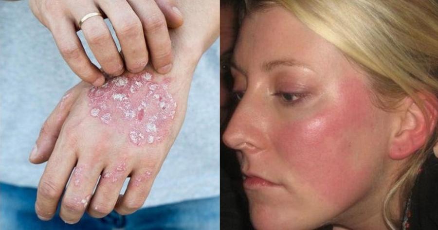 Επτά αυτοάνοσα νοσήματα που εμφανίζονται συχνότερα στις γυναίκες