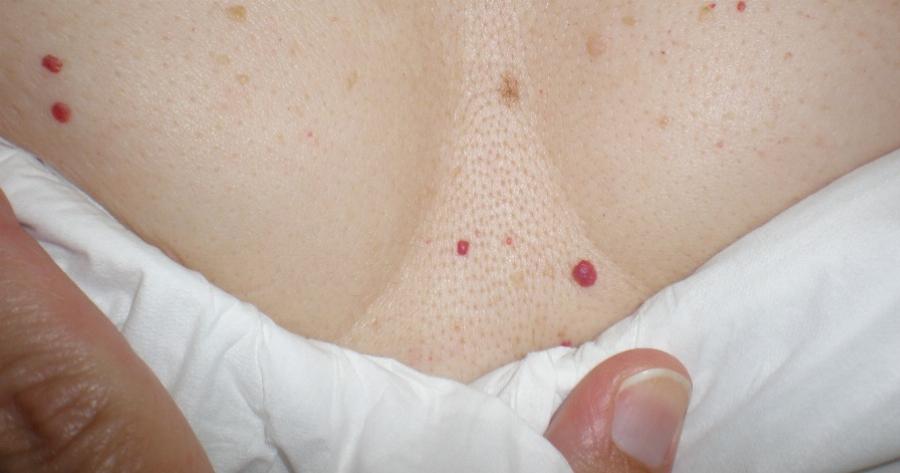 Κόκκινες ελιές: Τι είναι, πότε εμφανίζονται και τι σημαίνουν για την υγεία μας