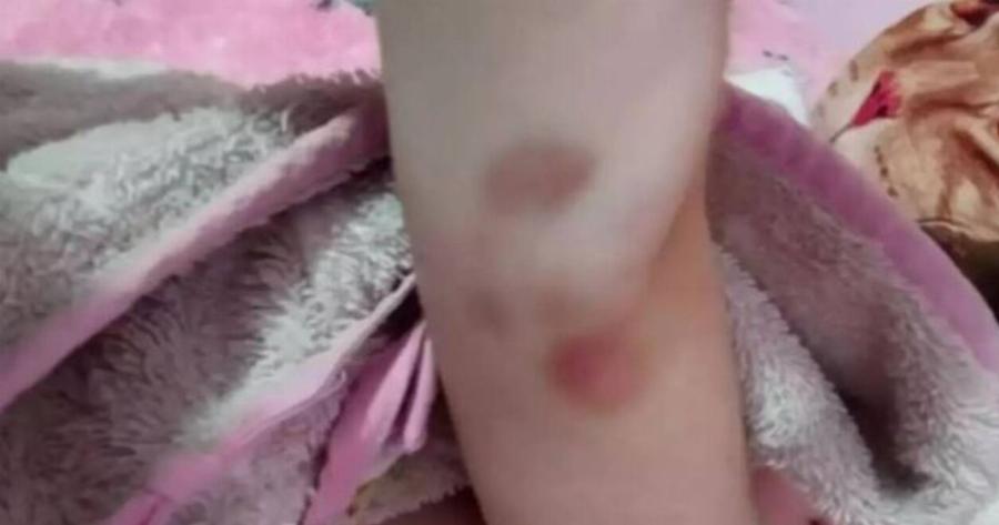 Εξελίξεις στην Πάτρα: Φωτογραφία – ντοκουμέντο από τις μελανιές στο χέρι της 9χρονης Τζωρτζίνας